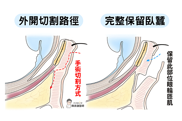 想消除重度結構性黑眼圈，需藉由外開眼袋來處理