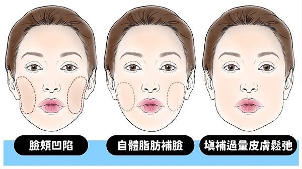 自體脂肪補臉豐頰若過量、加上皮膚鬆弛，容易導致下垂