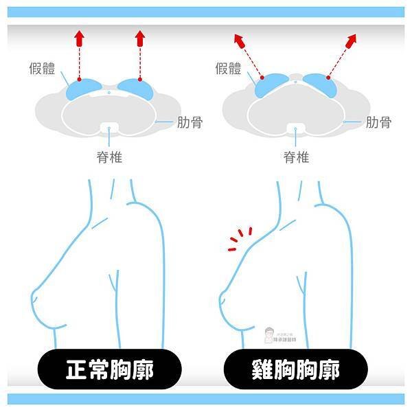 有雞胸問題的人在隆乳後是不容易有乳溝的