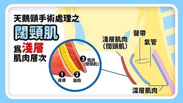 天鵝頸手術傷及聲帶或氣管的風險非常小，因為闊頸肌屬於淺層肌肉