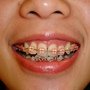 20100423-上下排矯正器