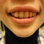 20100423-戴1月2週上排近照
