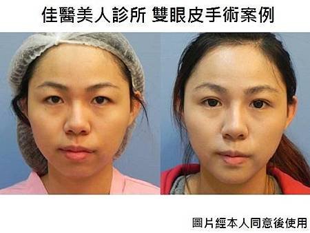 雙眼皮術前術後照.jpg