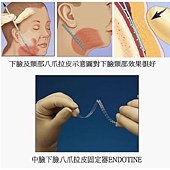 台中拉皮手術專欄｜內視鏡八爪拉皮文章用圖｜菲仕美羅仁傑醫師.jpg