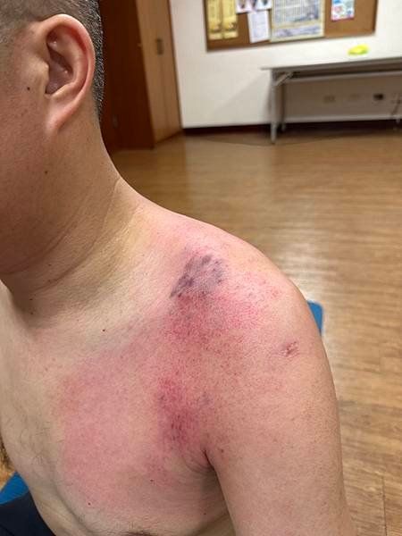 手臂麻痛怎麼辦？拍打經絡後成功緩解半夜痛醒的困擾