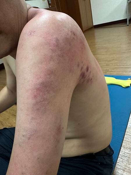 手臂麻痛怎麼辦？拍打經絡後成功緩解半夜痛醒的困擾