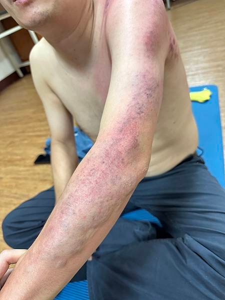 手臂麻痛怎麼辦？拍打經絡後成功緩解半夜痛醒的困擾