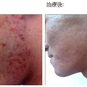 SOTHYS透明質酸MTS療程