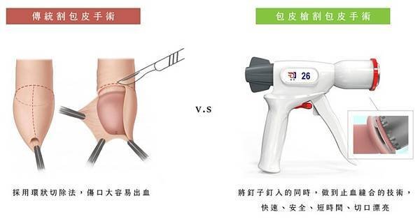 新莊外科，新莊割包皮，包皮槍手術