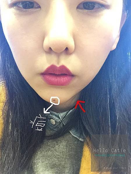 【美之約成功案例】[醫美] 立即有感的超強小臉效果 晶亮瓷(