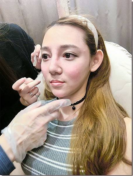 【美之約成功案例】〔美之約診所晶亮瓷&amp;水無痕玻尿酸。醫美〕打