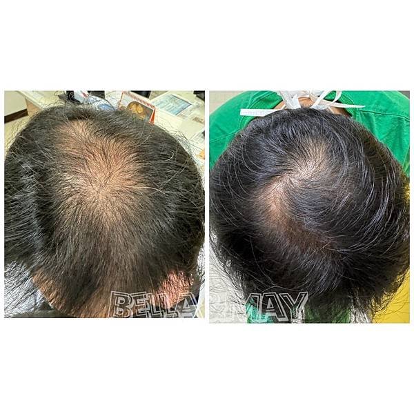 【台南專業紋繡．髮際線、飄眉、霧眉、眼線、霧唇】外泌體創髮課