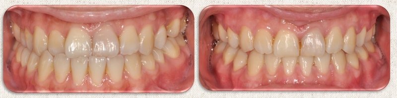 牙齒戴蒙Damon矯正推薦案例發表--中壢
