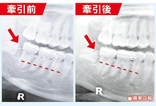 兩段式拔智齒