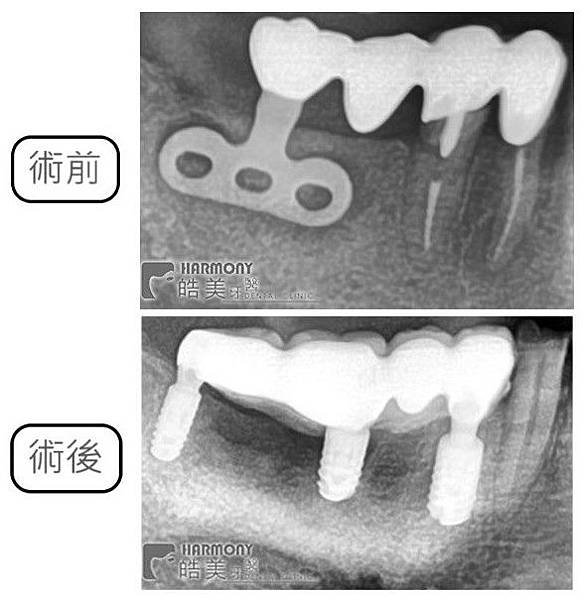 術前後.jpg
