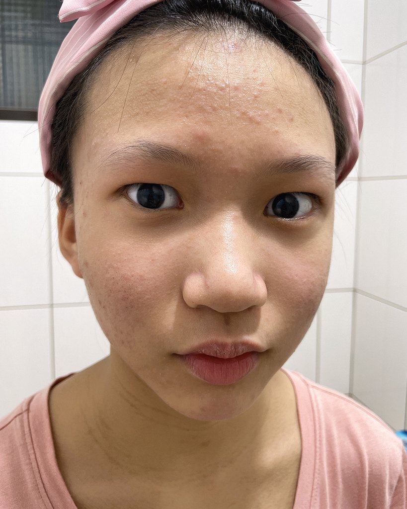 有感淨痘精華液8.jpg