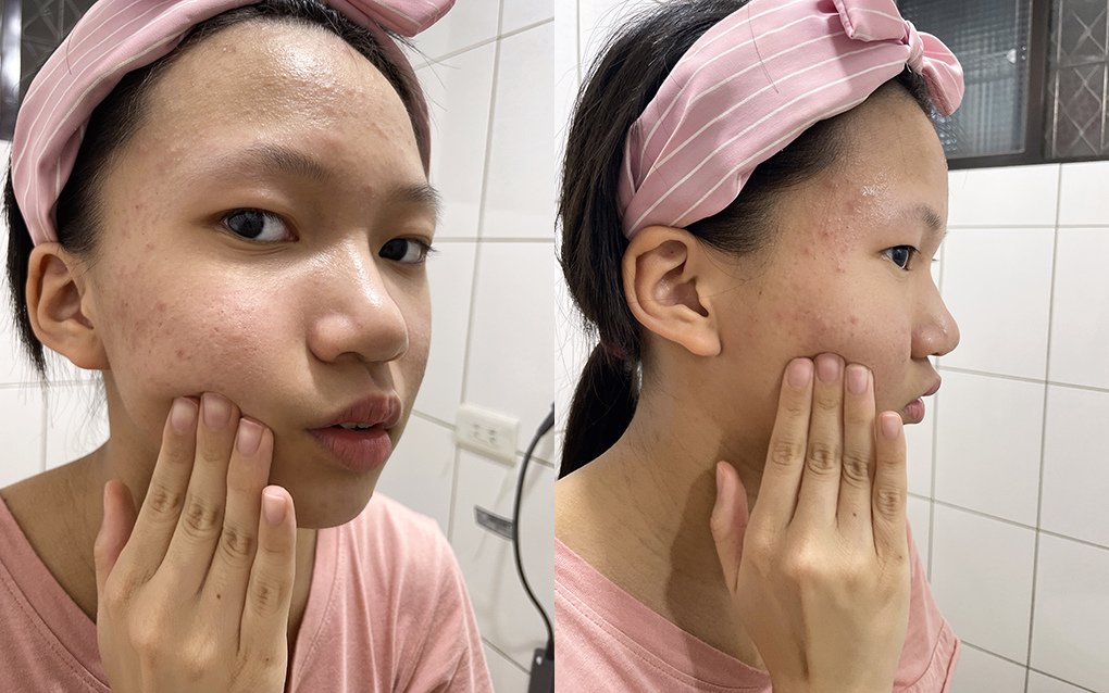 有感淨痘精華液10.jpg