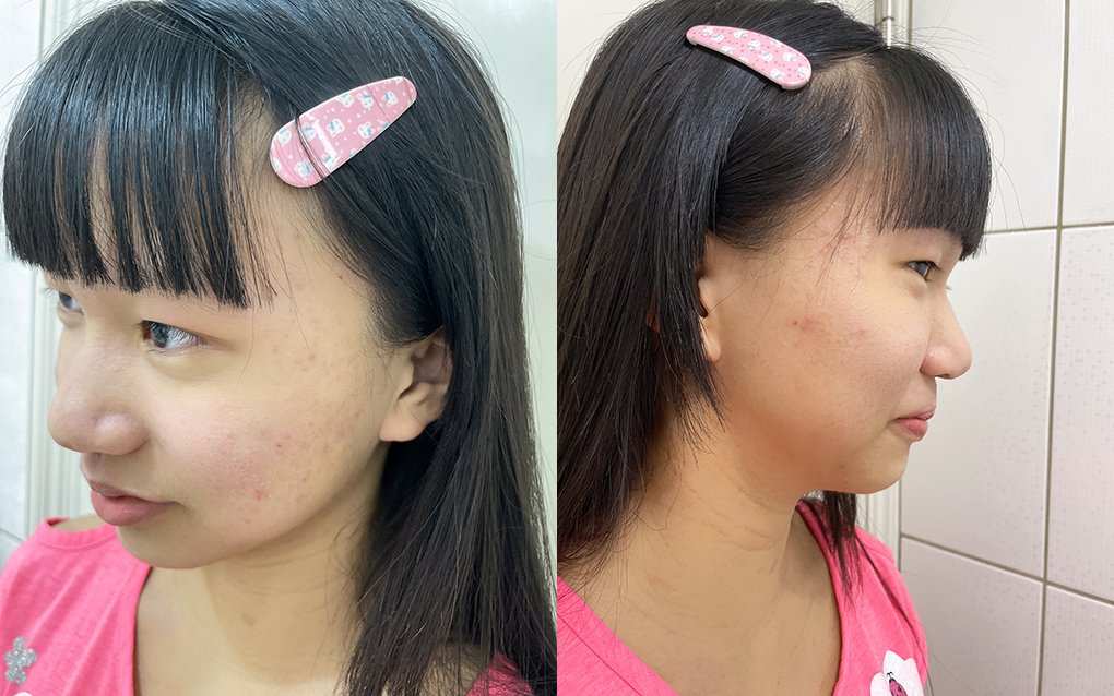 有感淨痘精華液12.jpg