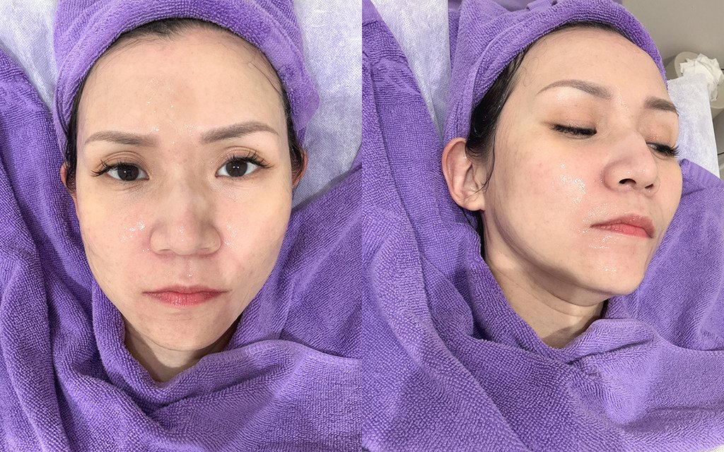 愛爾麗診所- HIPRO-S龍捲風音波拉提12.jpg