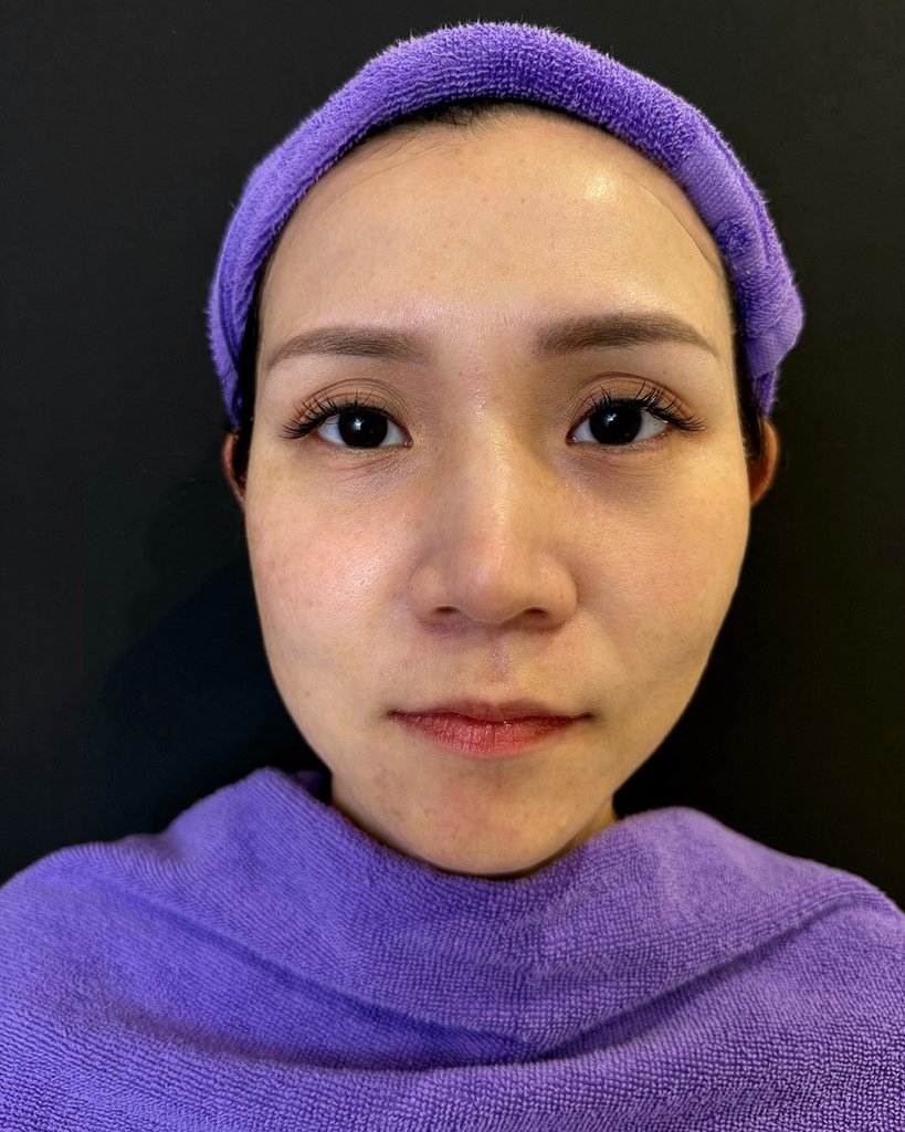 愛爾麗診所- HIPRO-S龍捲風音波拉提14.jpg