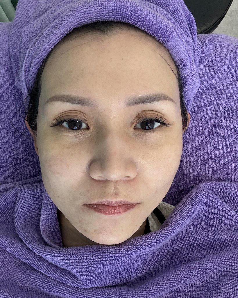 愛爾麗診所- HIPRO-S龍捲風音波拉提16.jpg