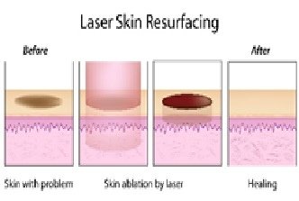 laser.jpg