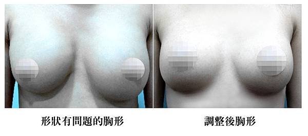 果凍矽膠隆乳01.jpg