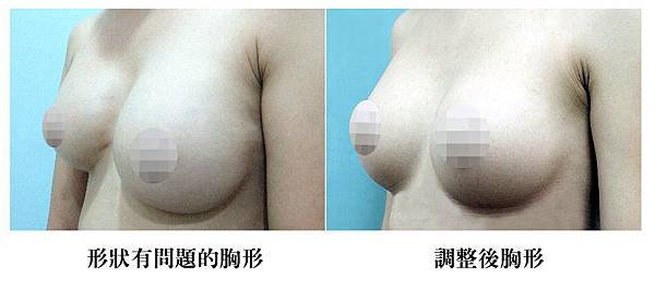 果凍矽膠隆乳03.jpg