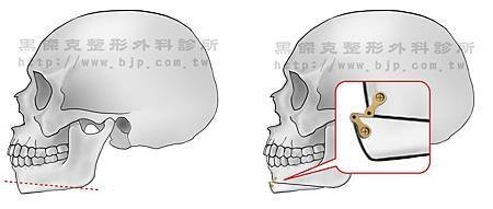 Cheekbone 削骨-下巴後縮01.jpg