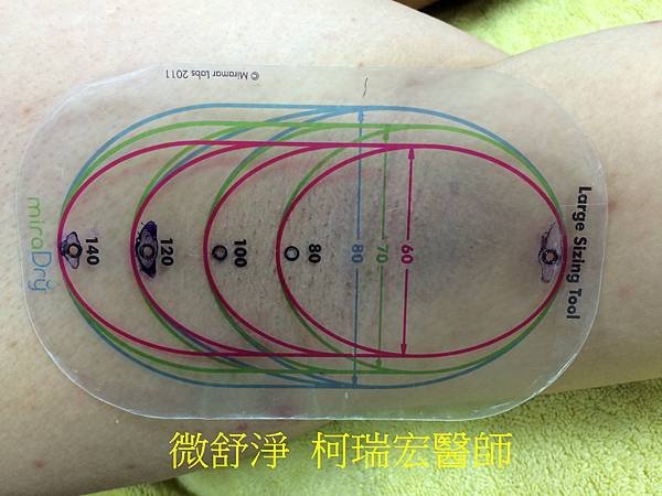 微舒淨MiraDry微波除汗