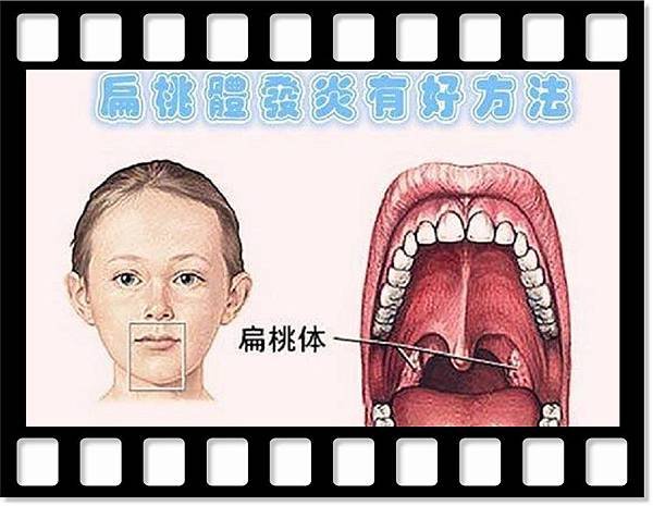 扁桃體發炎有好方法