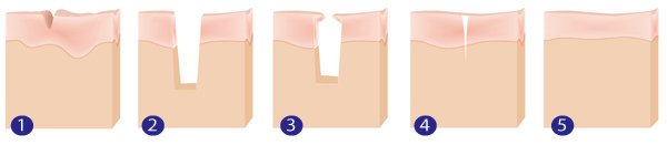 tightening_mechanism
