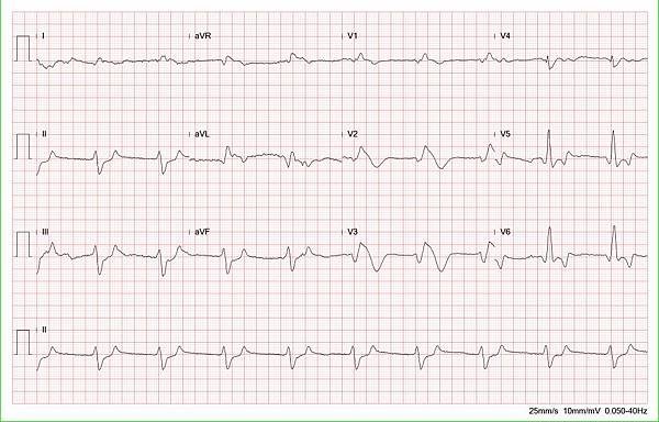  K7.9 ECG fix.jpg