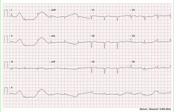  cardiac temponate ECG fix.jpg