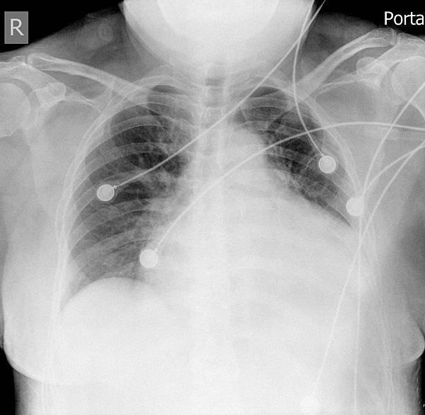CXR fix.jpg