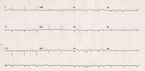 ECG_low_voltage_anterior_MI