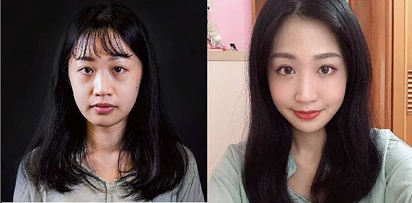 自體脂肪補臉 (5).jpg
