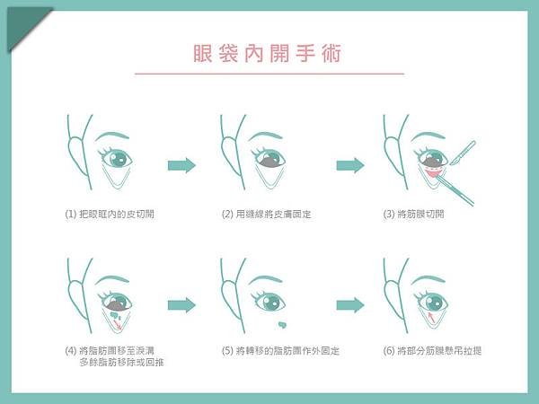 眼袋內開.jpg