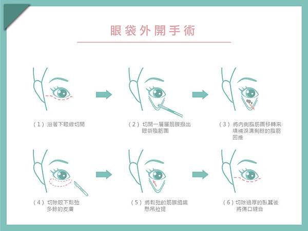 眼袋外開.jpg