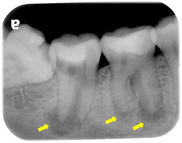 根尖病灶.jpg