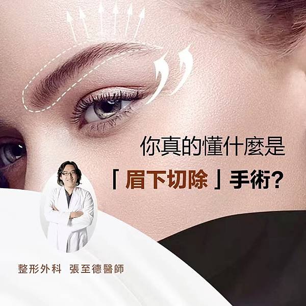 張至德醫師 – 你真的懂什麼是「眉下切除」手術？.jpg