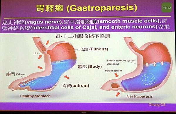 國防醫學院：赴比利時魯汶「胃輕癱之流行病學 病生理及治療選