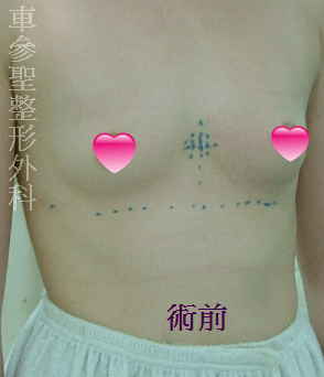 內視鏡隆乳