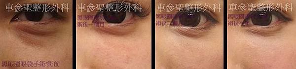 黑眼圈眼袋手術
