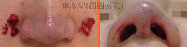 內開隱形縮鼻頭手術