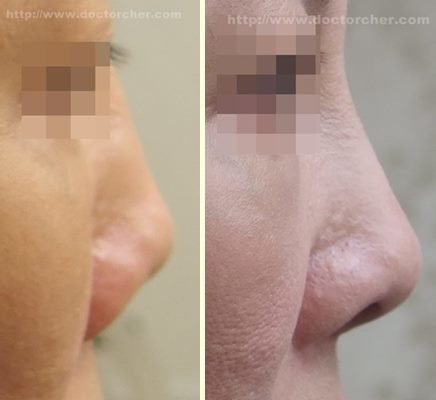 內開式全自體耳軟骨鼻尖形成術