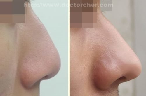 內開式全自體耳軟骨鼻尖形成術