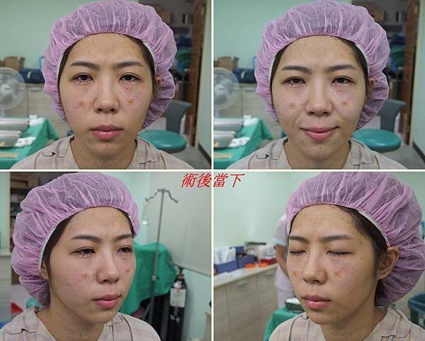 眼袋黑眼圈手術