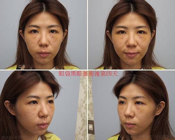 眼袋黑眼圈手術