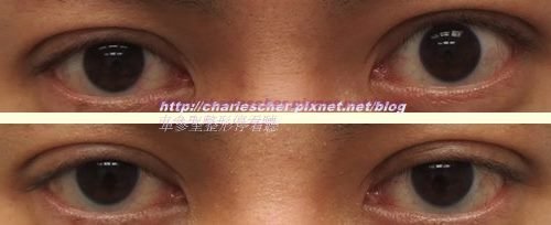 車參聖整形停看聽---52 提眼肌手術的另一種類型---驚訝眼的處理